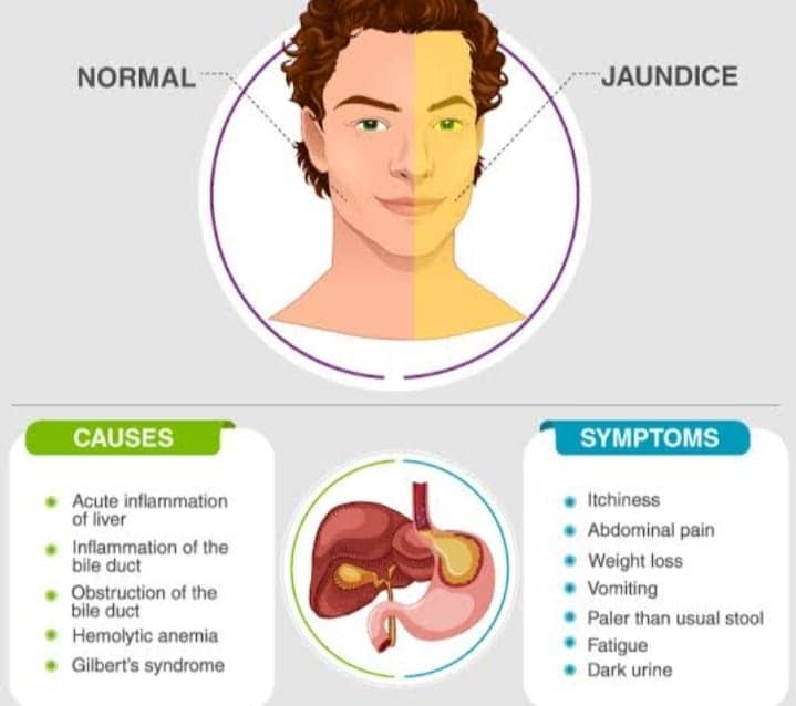 jaundice-meaning-in-hindi-what-is-jaundice-in-hindi-full-detail